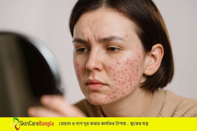 মেছতা ও দাগ দূর করার উপায়